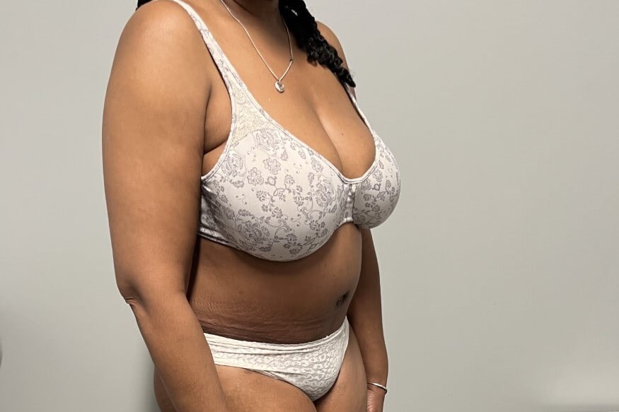 Tummy Tuck with Liposuction After Tummy Tuck with Liposuction After