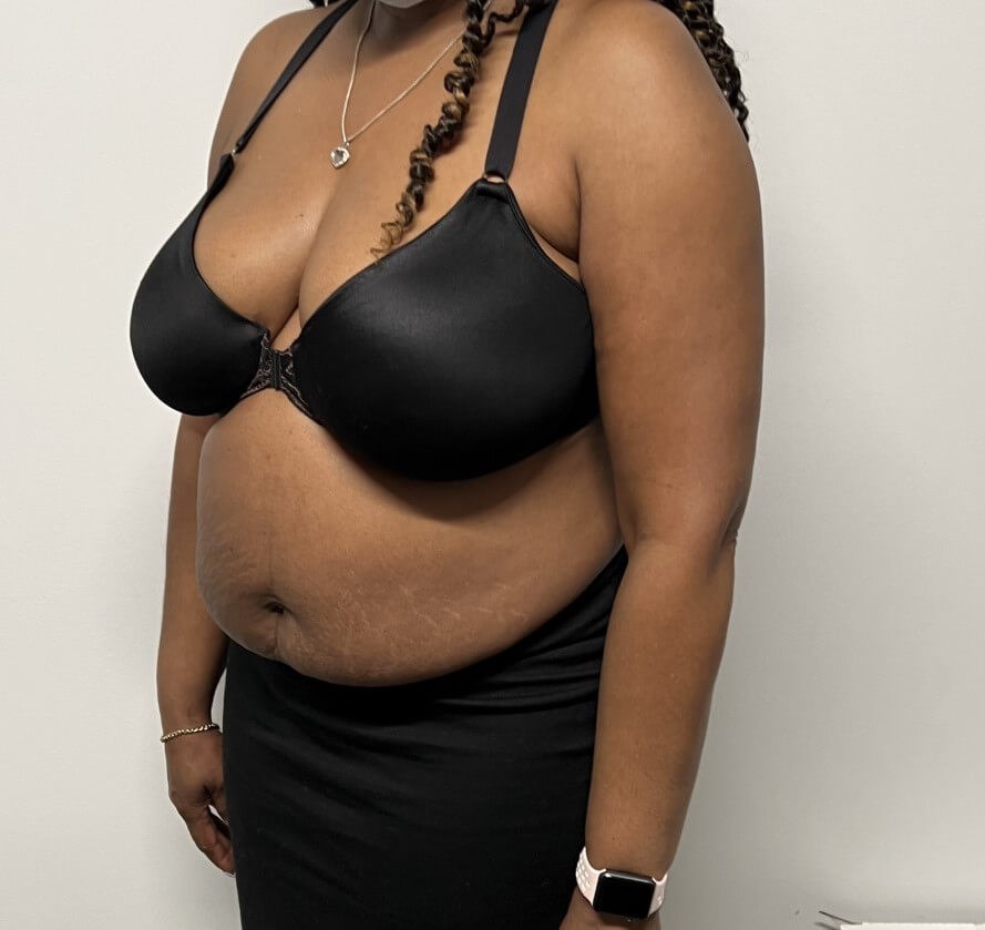 Tummy Tuck with Liposuction Before Tummy Tuck with Liposuction Before