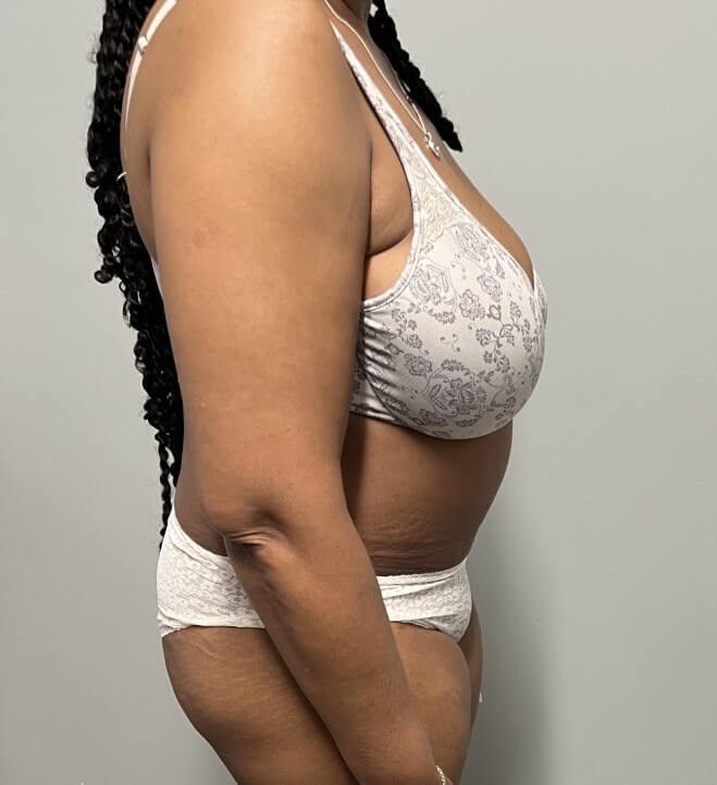 Tummy Tuck with Liposuction After Tummy Tuck with Liposuction After