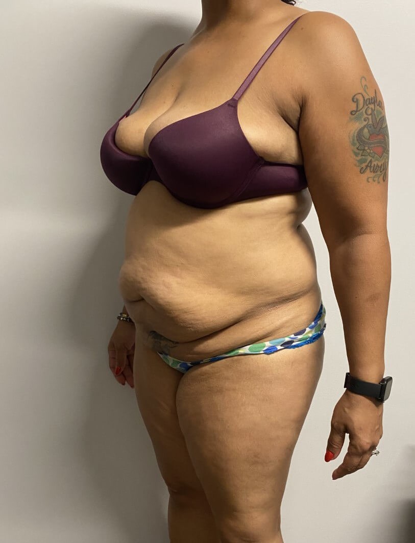 Abdominoplasty Surgery Before Abdominoplasty Surgery Before