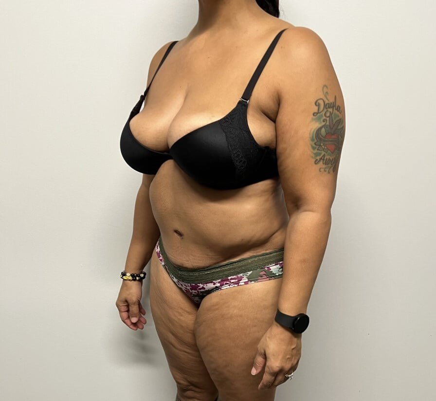 Abdominoplasty Surgery After Abdominoplasty Surgery After