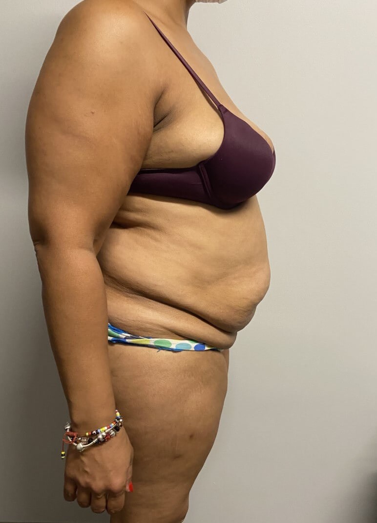 Abdominoplasty Surgery Before Abdominoplasty Surgery Before