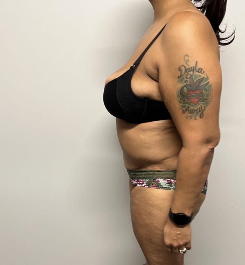 Abdominoplasty Surgery After Abdominoplasty Surgery After