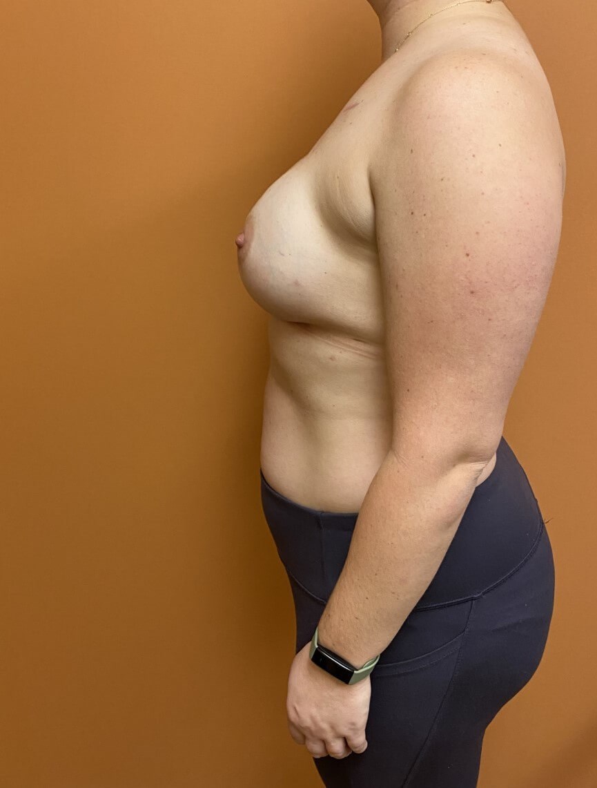 Nipple Sparing Reconstruction Before Nipple Sparing Reconstruction Before