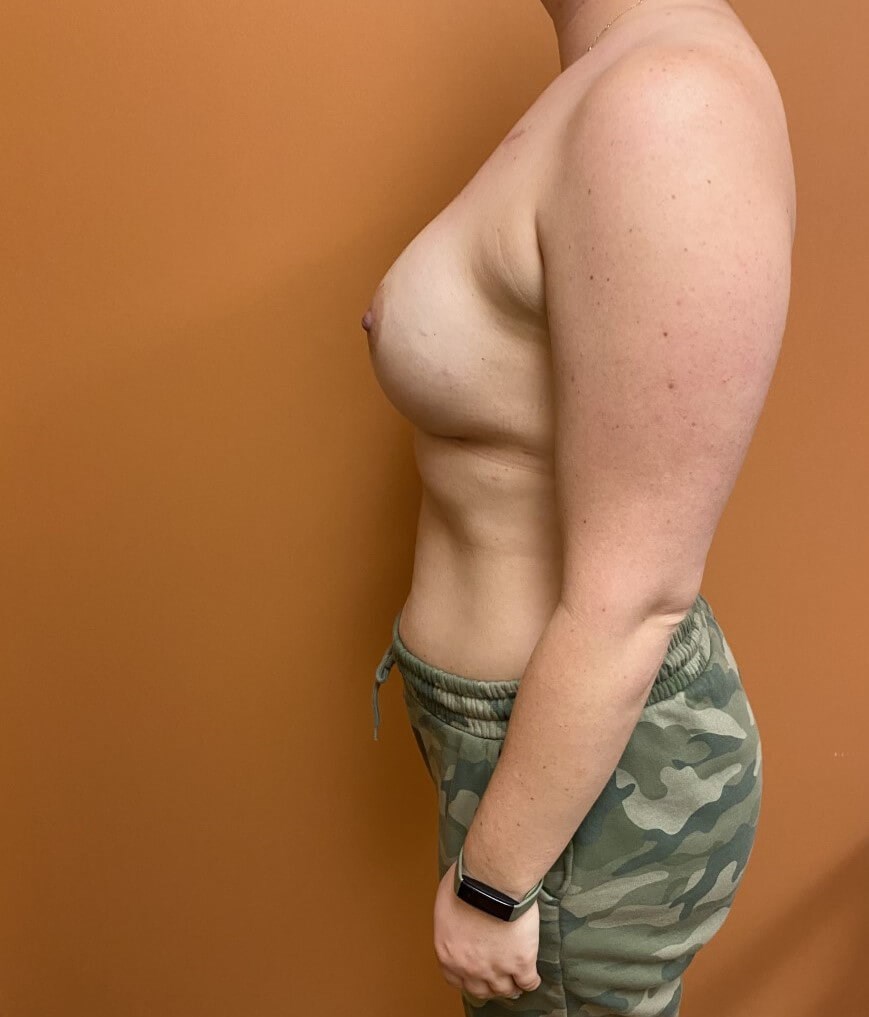 Nipple Sparing Reconstruction After Nipple Sparing Reconstruction After