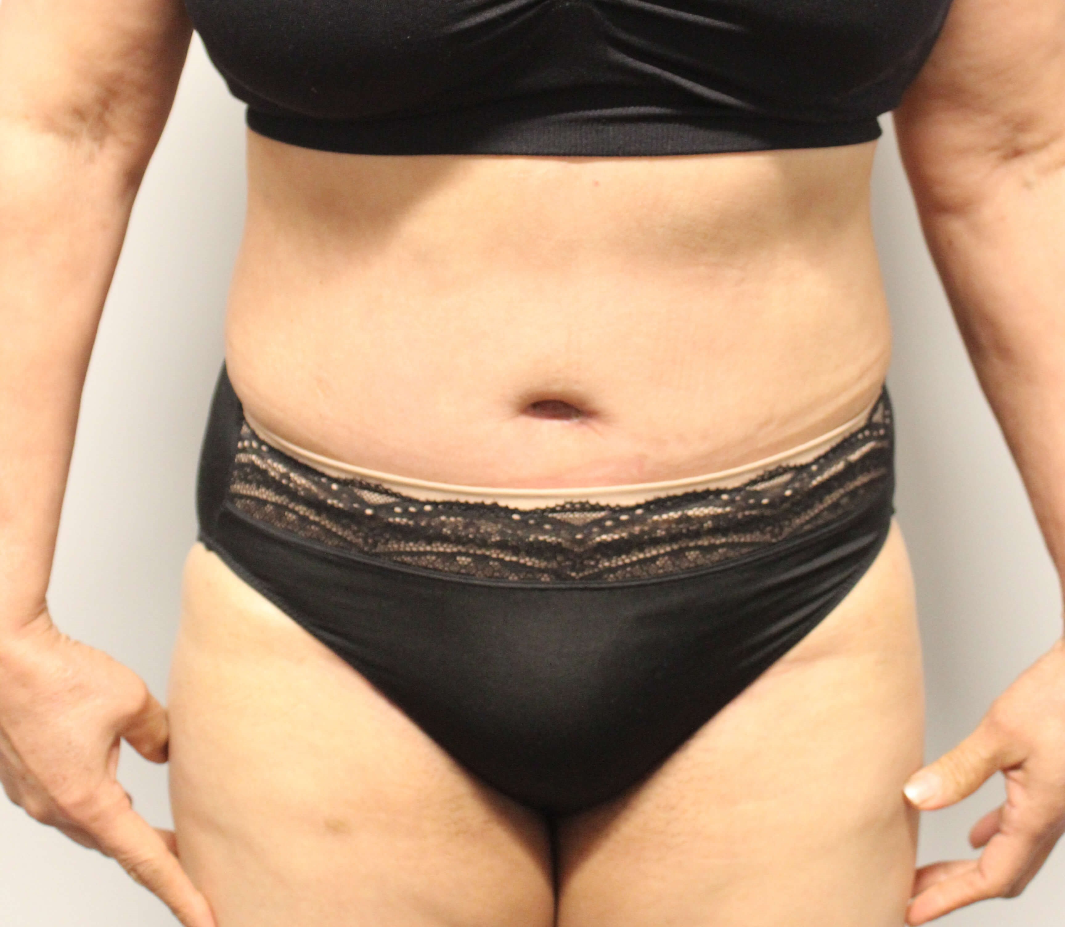 Abdominoplasty Surgery After Abdominoplasty Surgery After