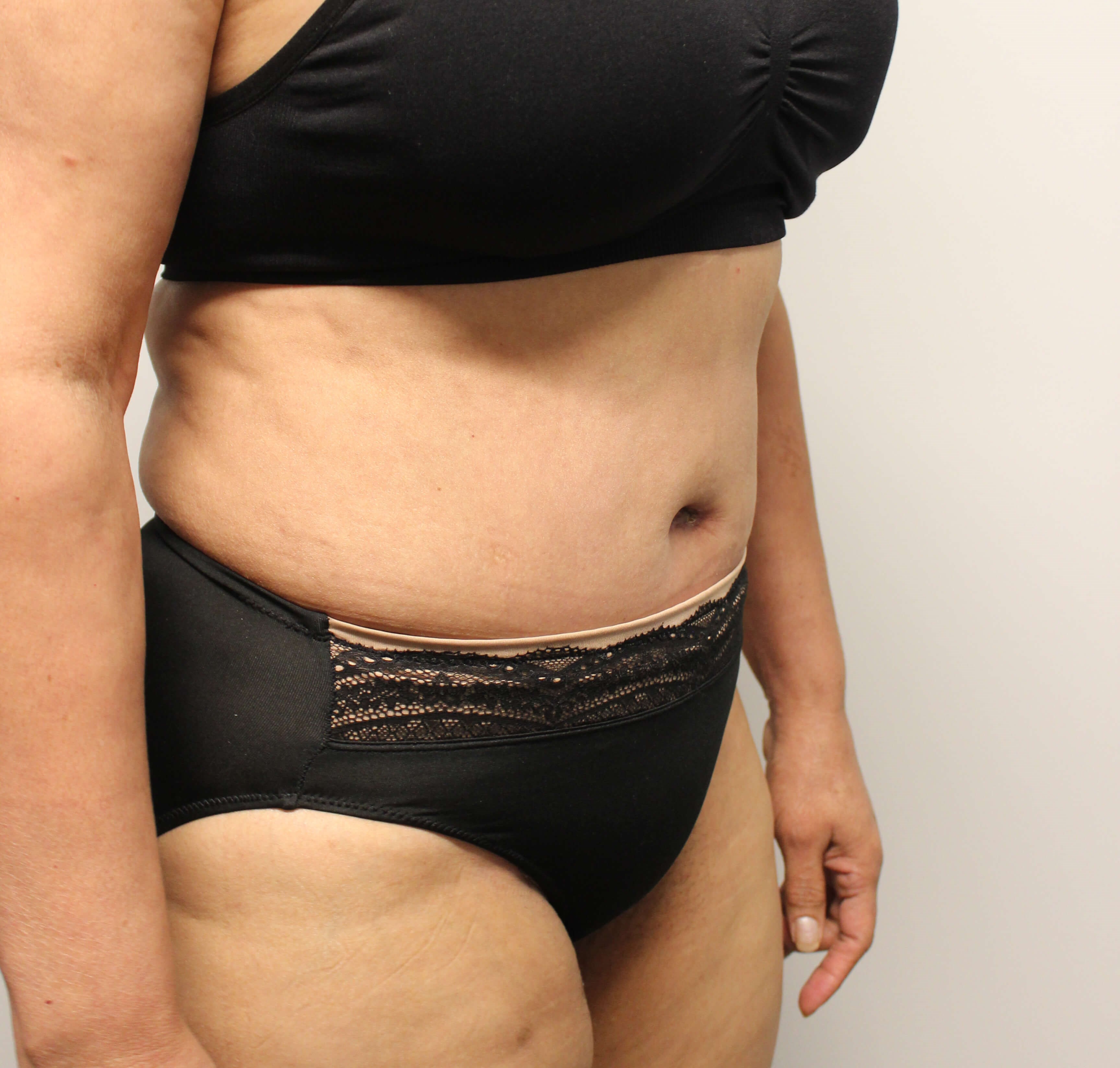Abdominoplasty Surgery After Abdominoplasty Surgery After