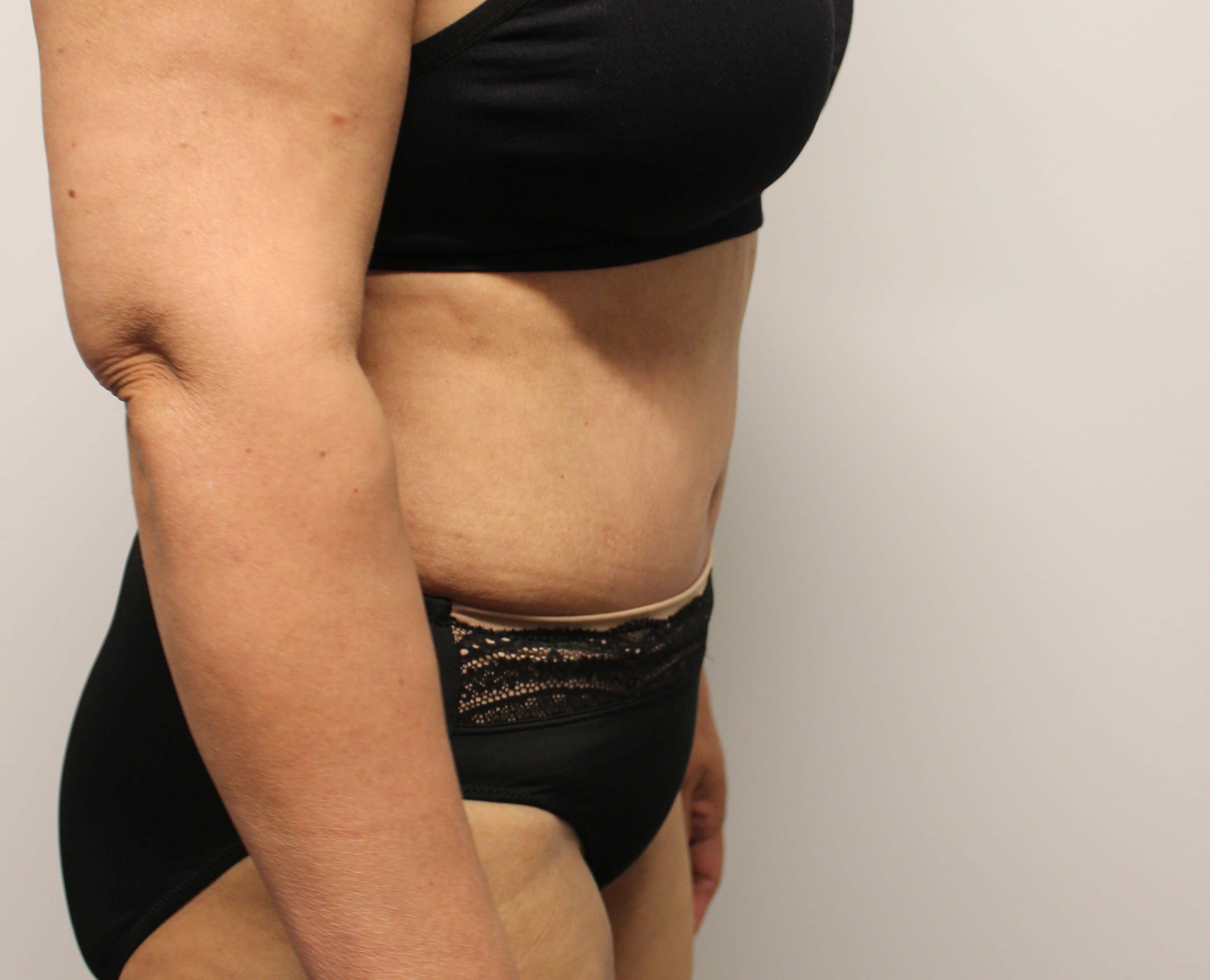 Abdominoplasty Surgery After Abdominoplasty Surgery After