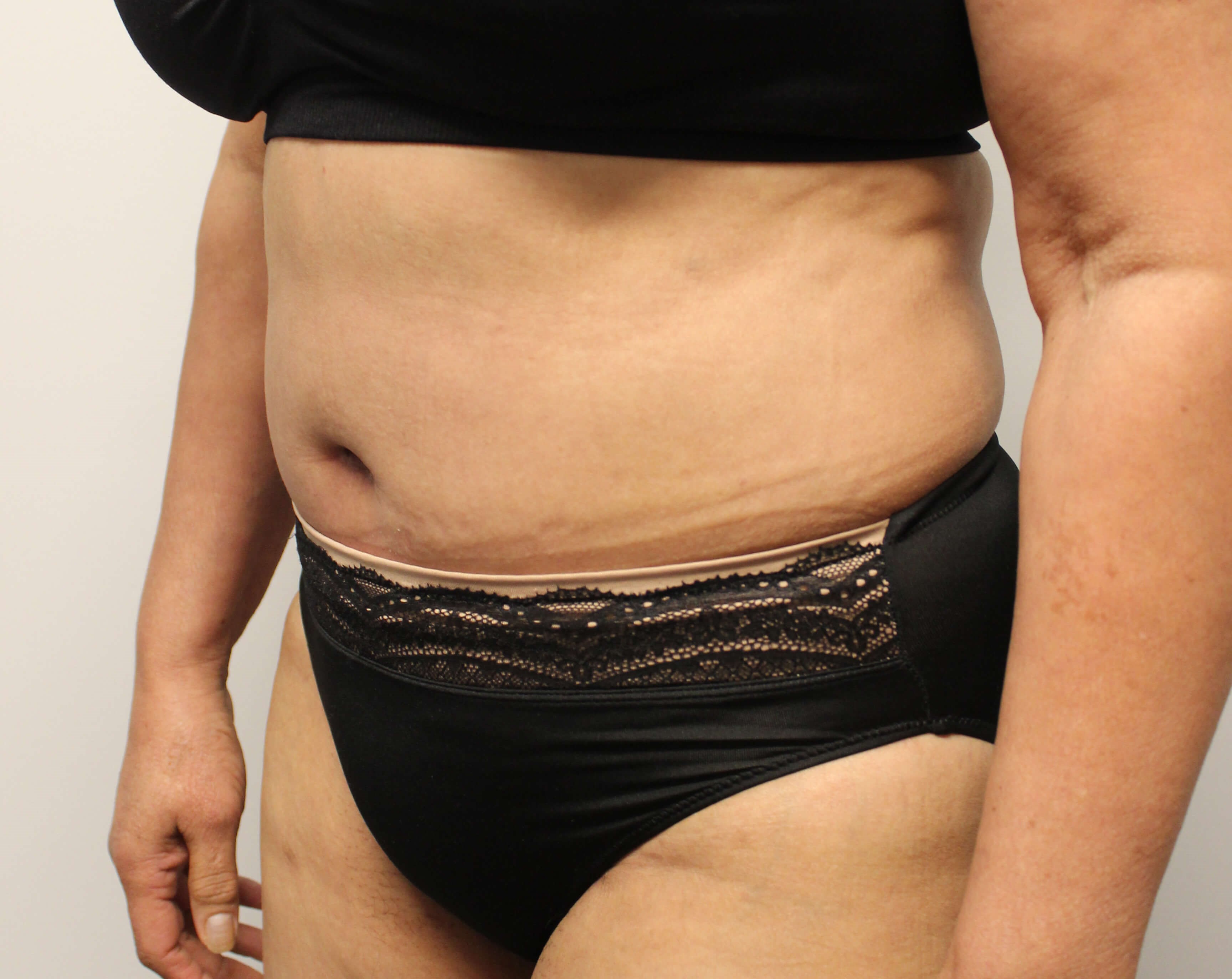 Abdominoplasty After Abdominoplasty After