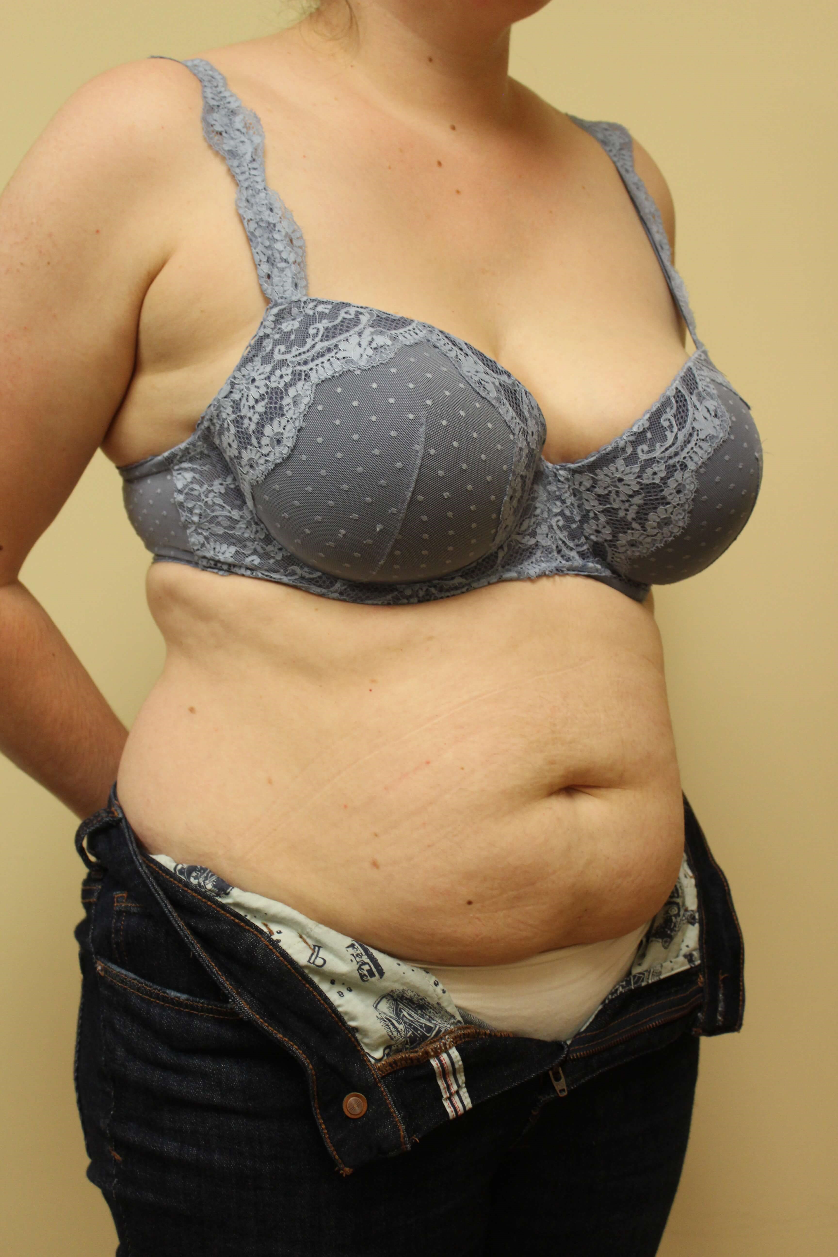Abdominoplasty Surgery Before Abdominoplasty Surgery Before