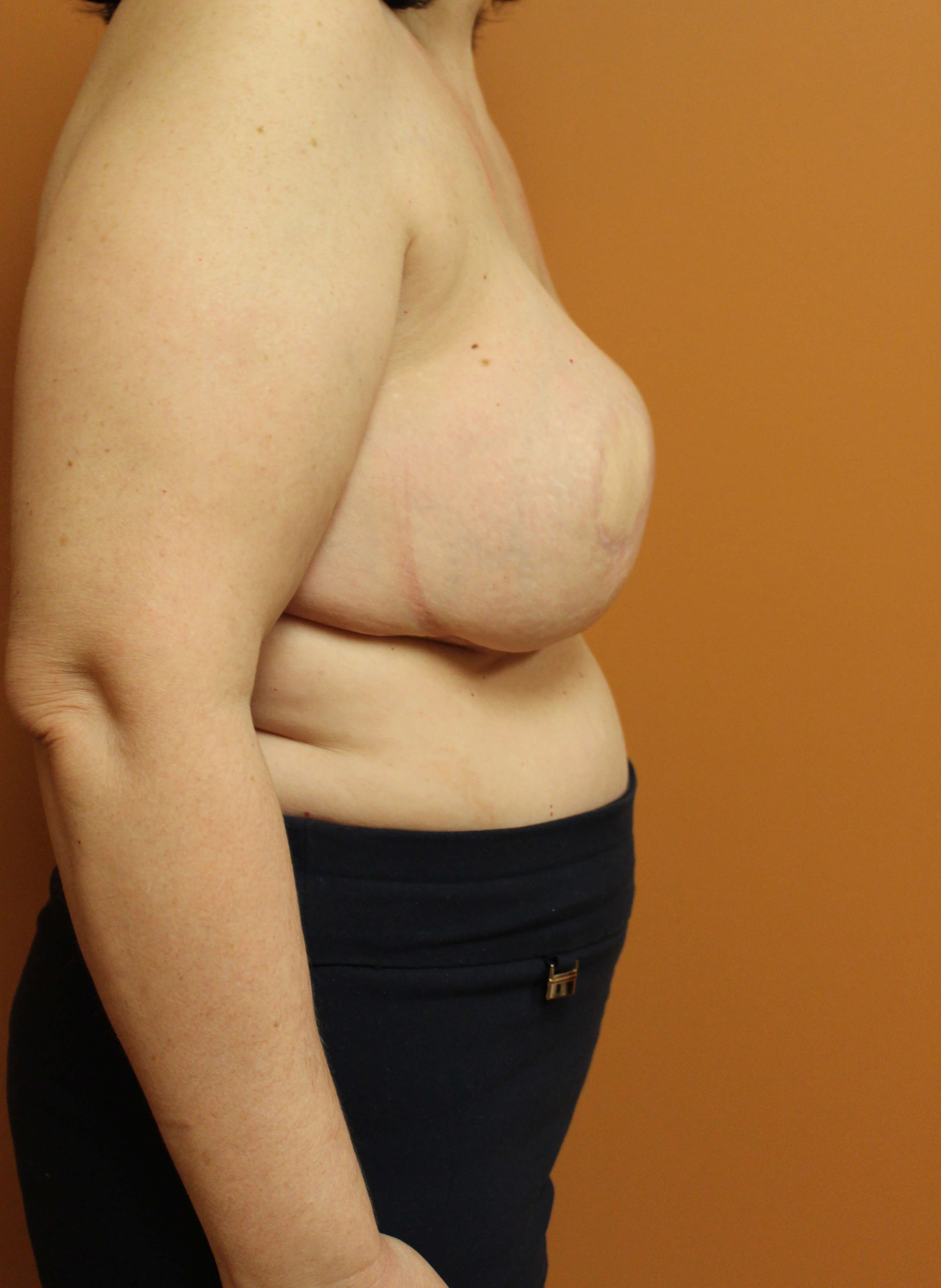 DIEP Flap Reconstruction After DIEP Flap Reconstruction After