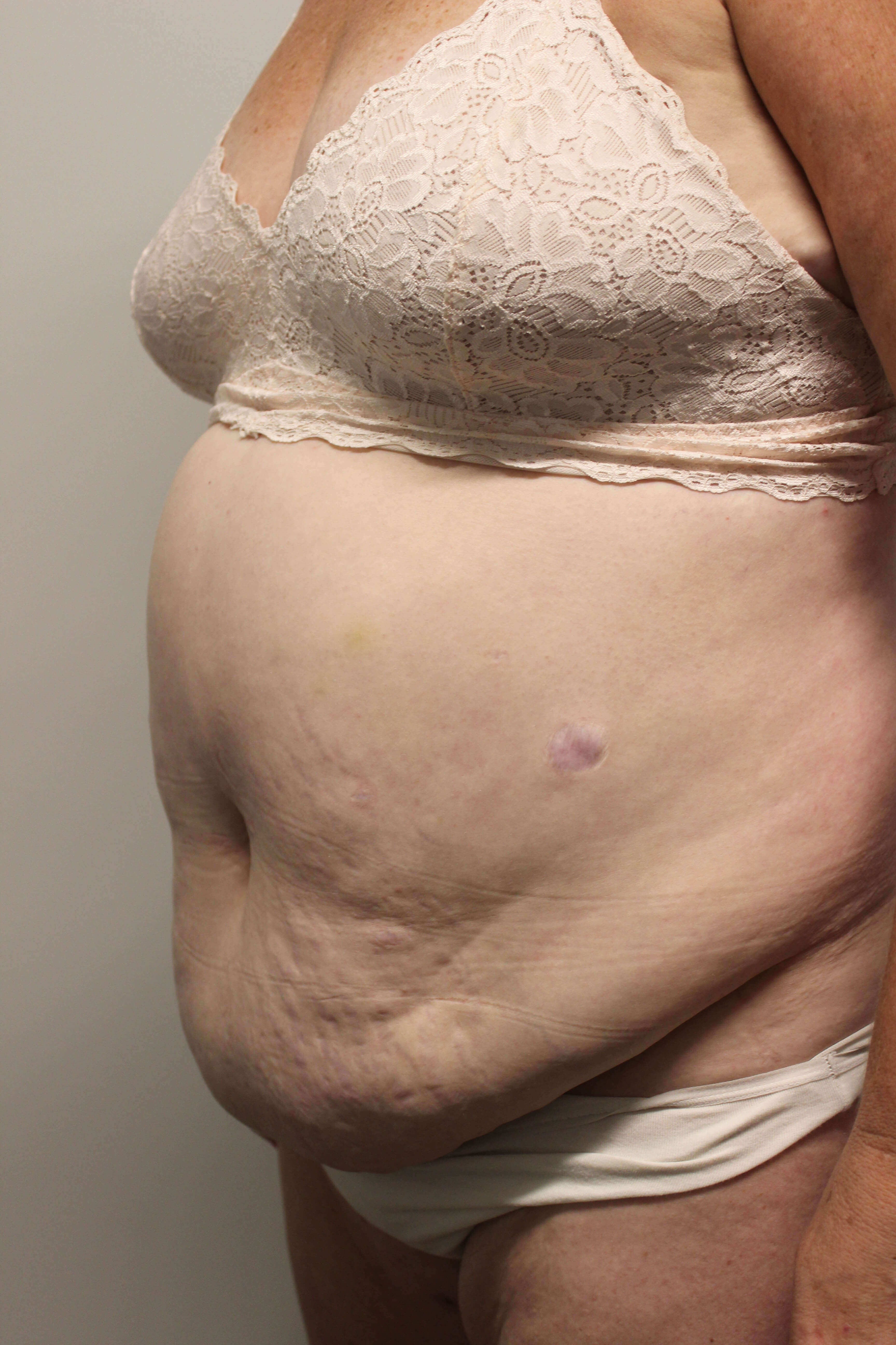 Tummy Tuck after weight loss Before Tummy Tuck after weight loss Before