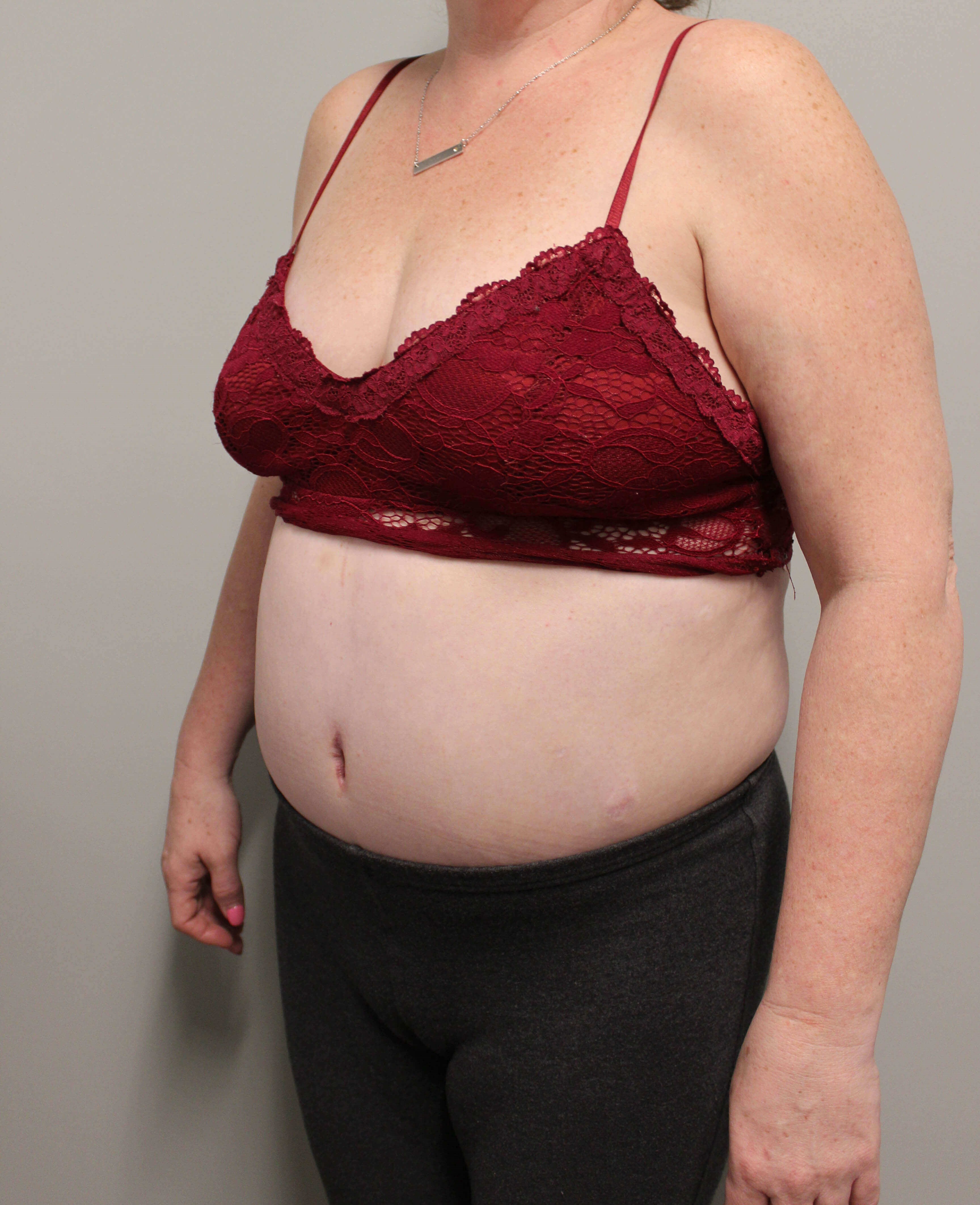 Tummy Tuck after weight loss After Tummy Tuck after weight loss After