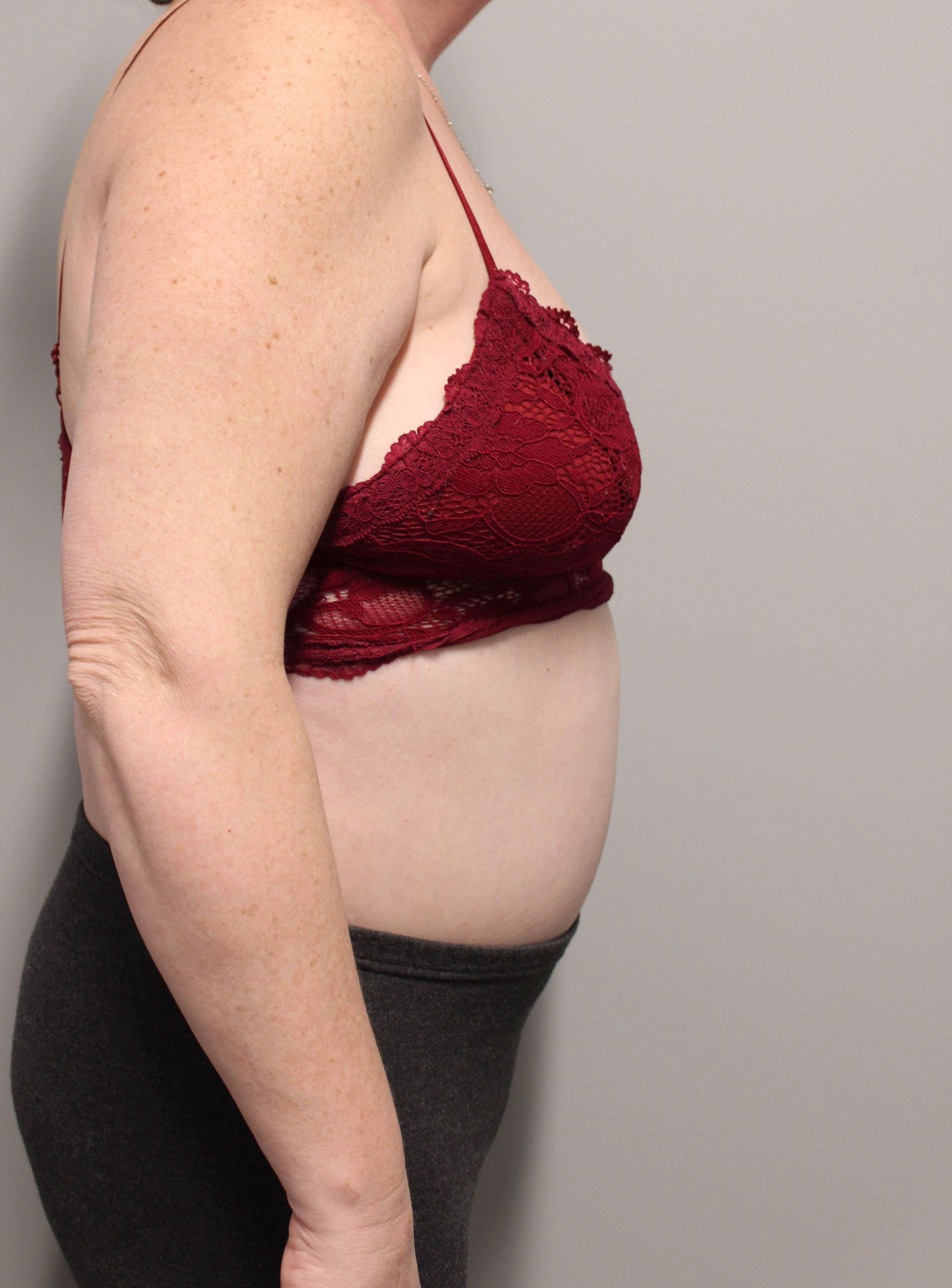 Tummy Tuck after weight loss After Tummy Tuck after weight loss After