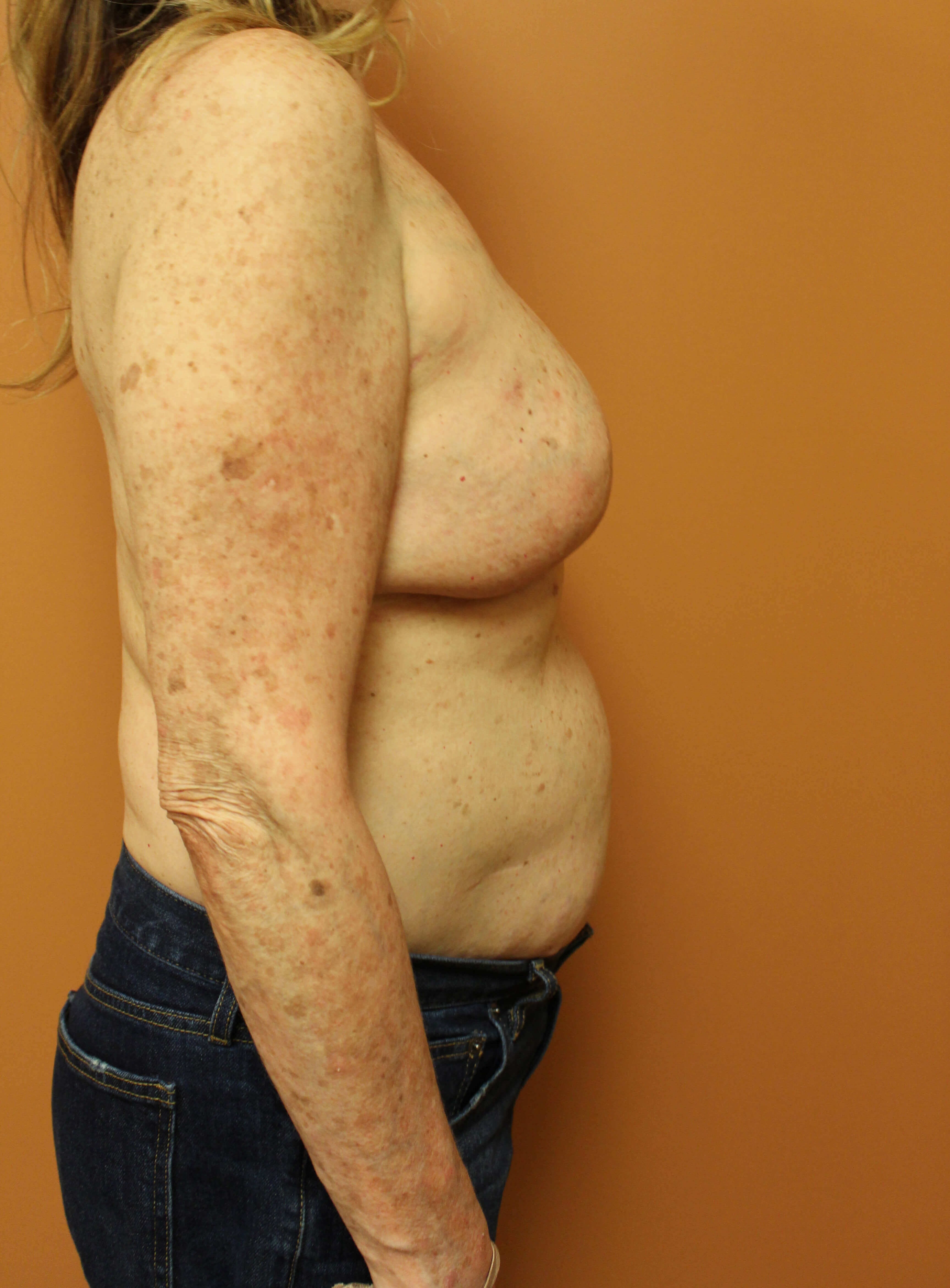 Tissue Expander with Reduction After Tissue Expander with Reduction After