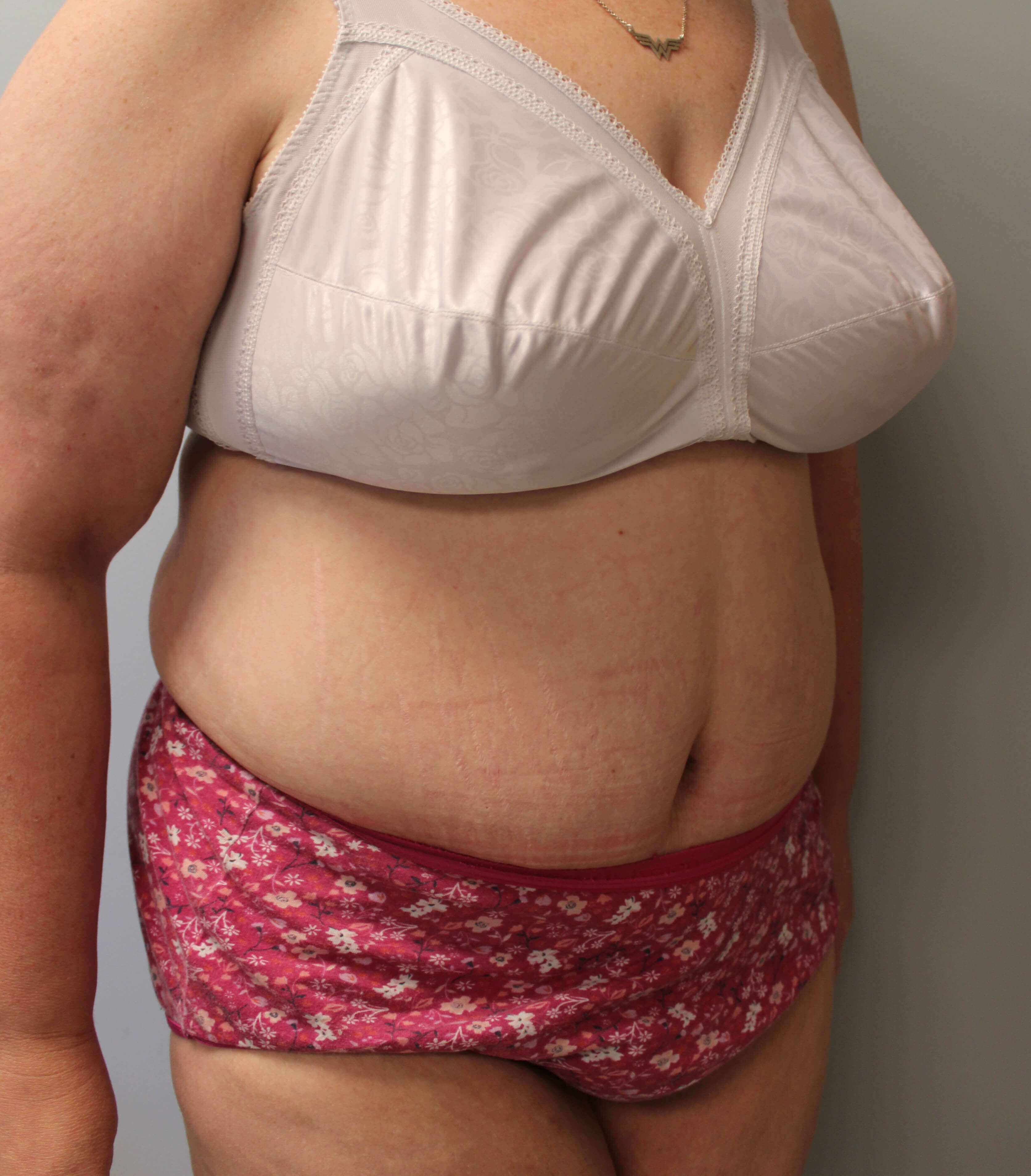 Tummy Tuck after weight loss Before Tummy Tuck after weight loss Before