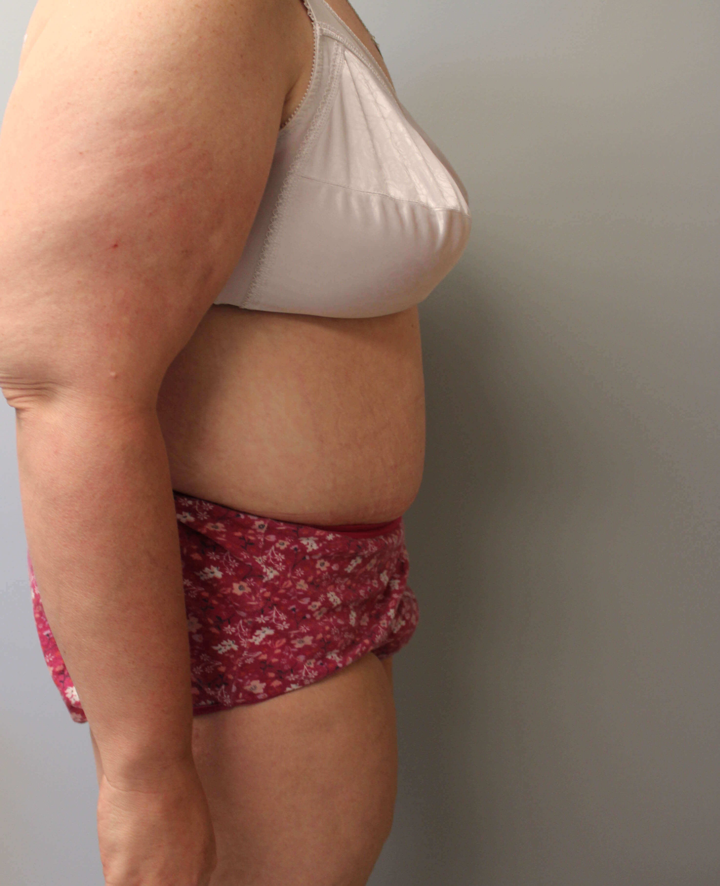 Tummy Tuck after weight loss After Tummy Tuck after weight loss After