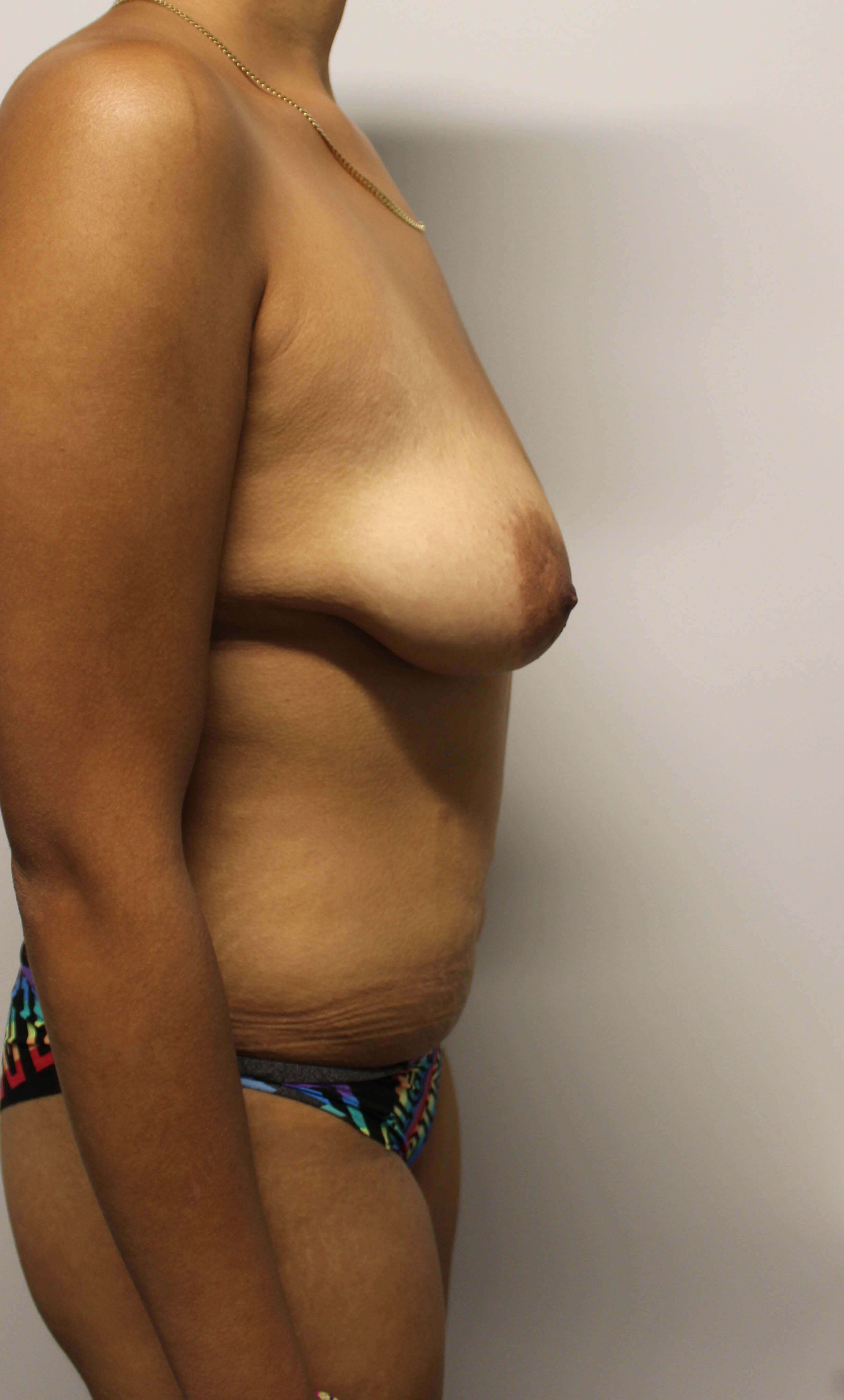 Breast Reduction Surgery Before Breast Reduction Surgery Before