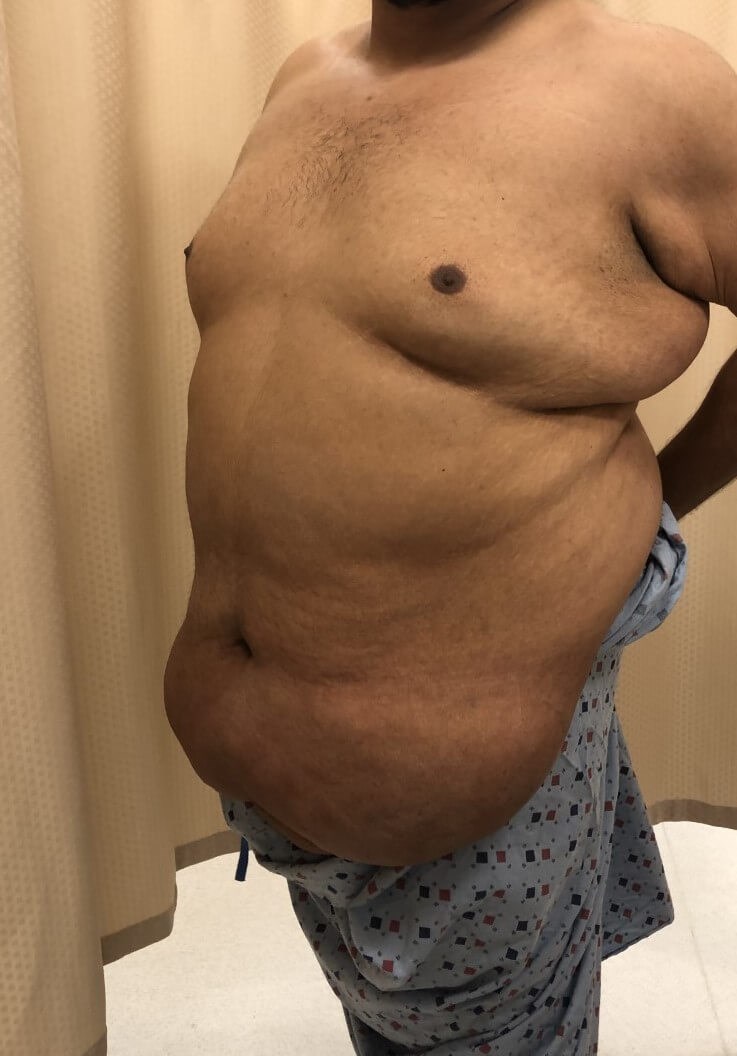 Male Tummy Tuck Before Male Tummy Tuck Before