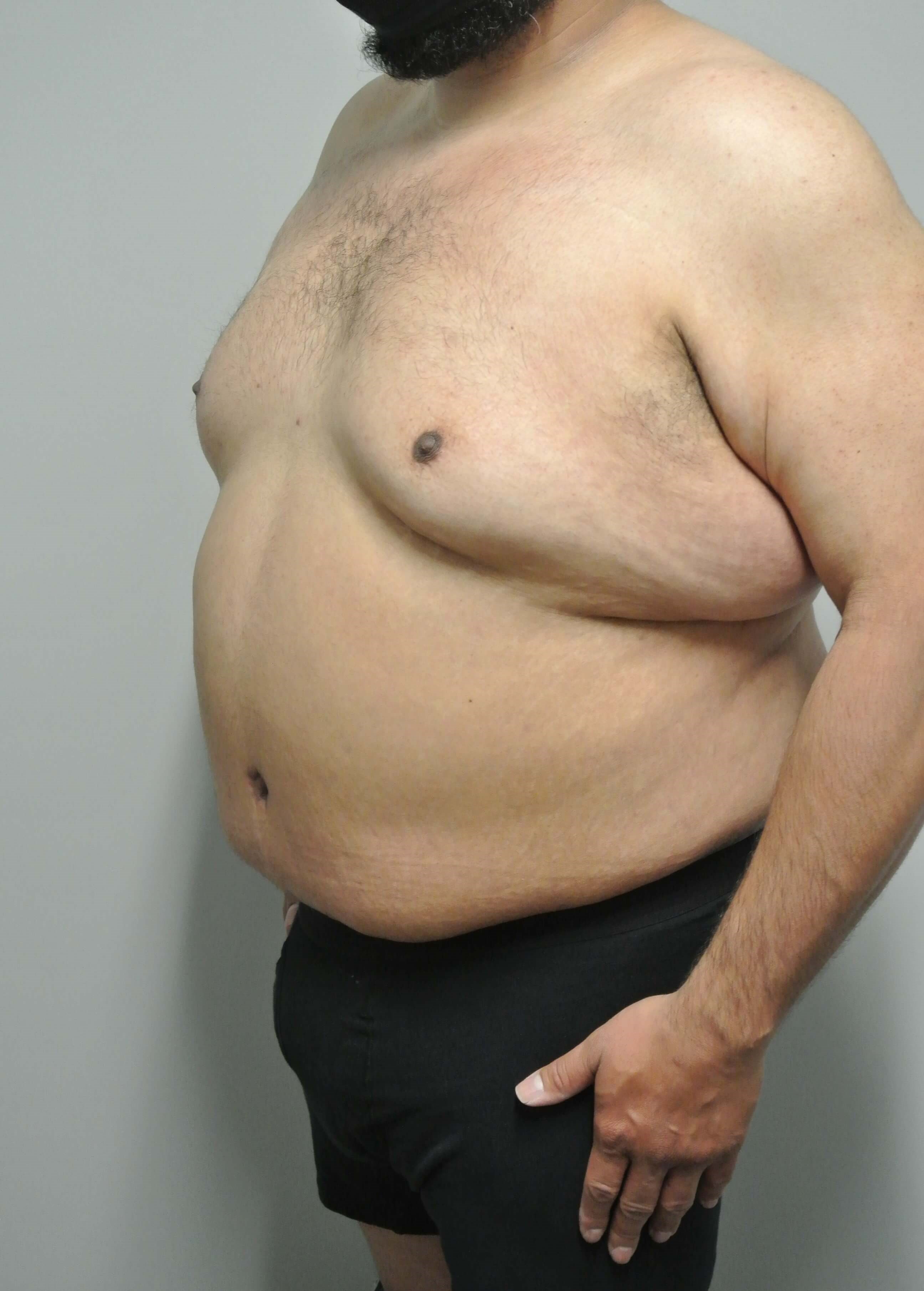 Male Tummy Tuck After Male Tummy Tuck After