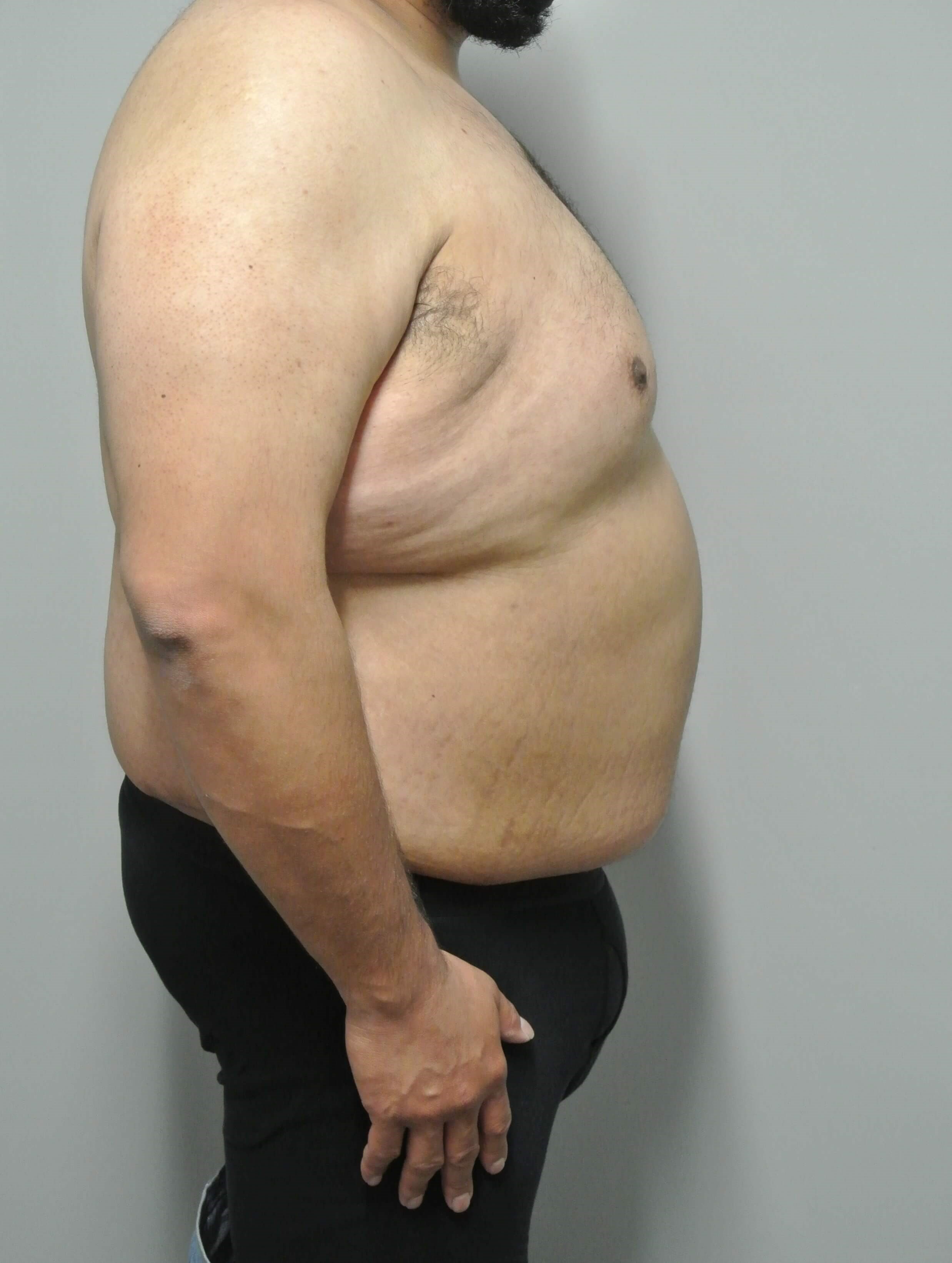 Male Tummy Tuck After Male Tummy Tuck After