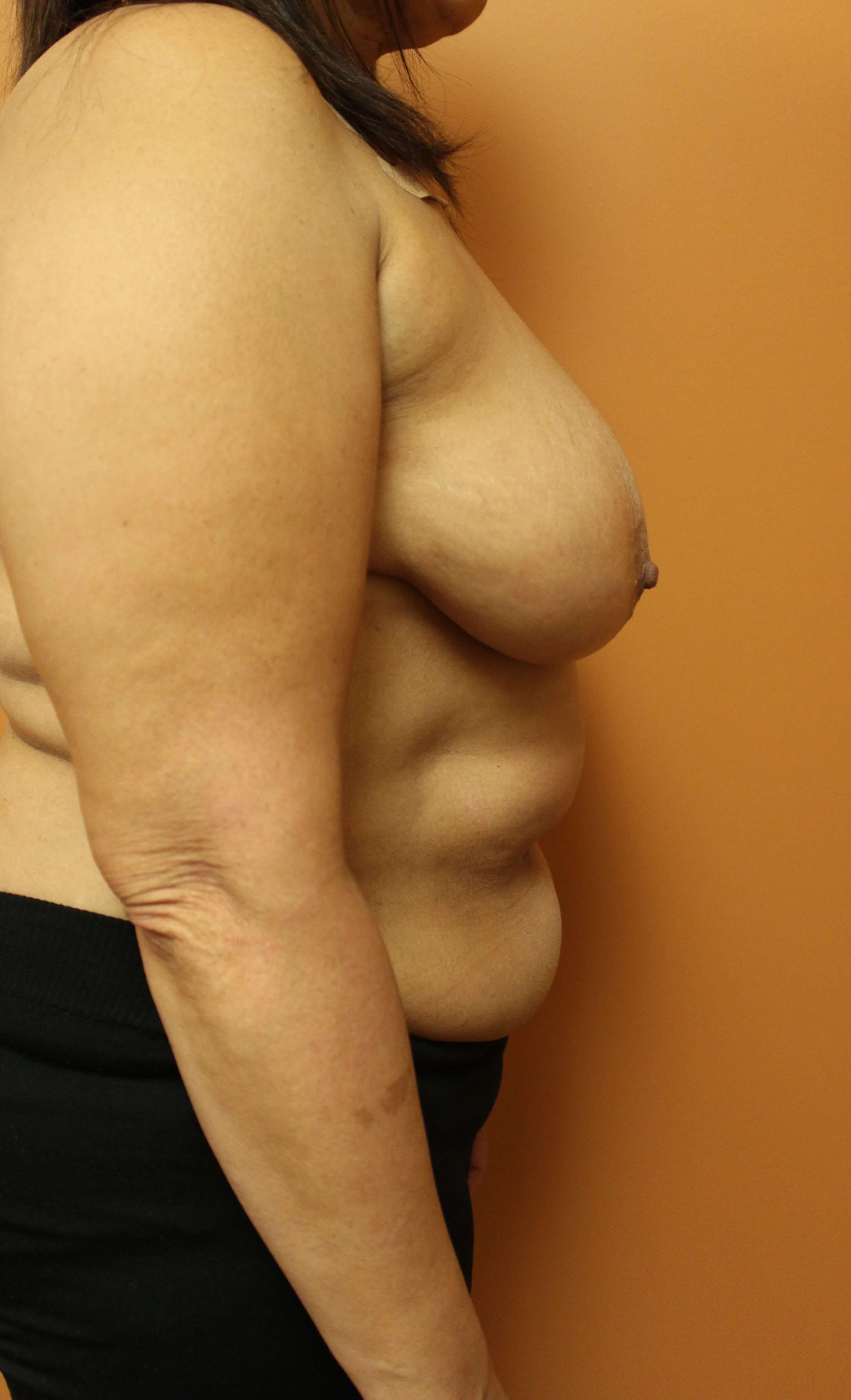 Right Breast DIEP Flap Before Right Breast DIEP Flap Before