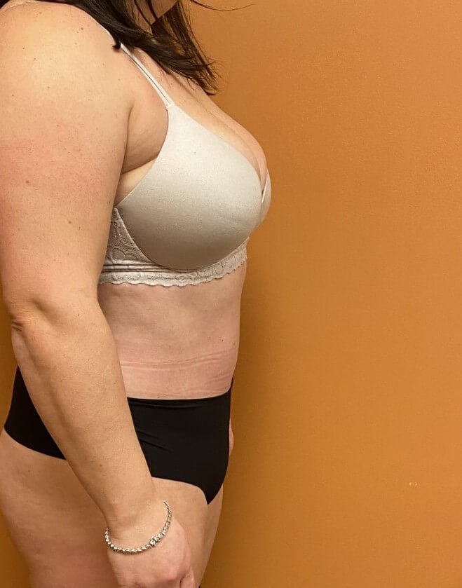 Tummy Tuck and Liposuction After Tummy Tuck and Liposuction After