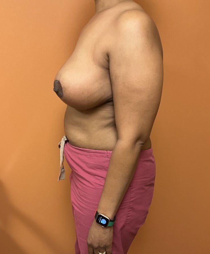 Breast Reduction After Breast Reduction After