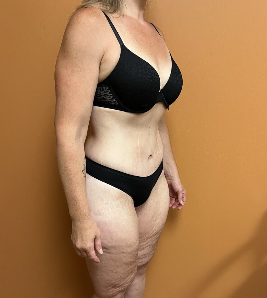 Tummy Tuck after weight loss After Tummy Tuck after weight loss After