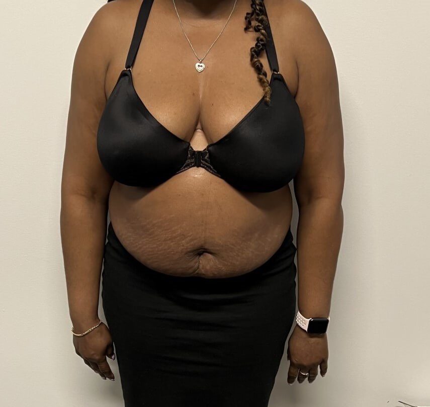 Tummy Tuck with Liposuction Before