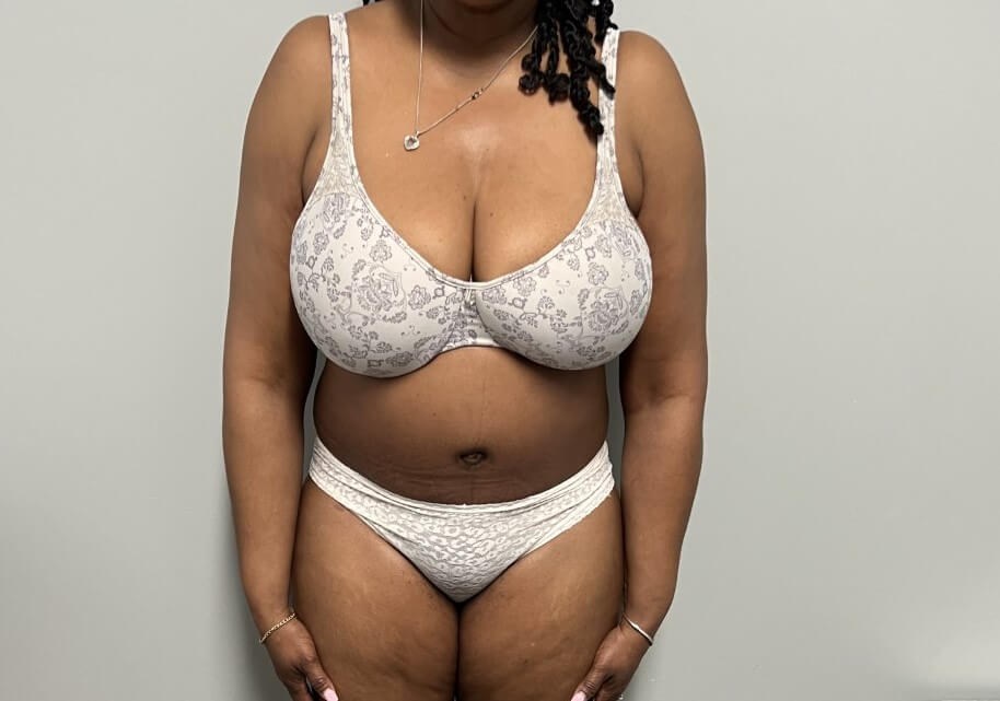 Tummy Tuck with Liposuction After