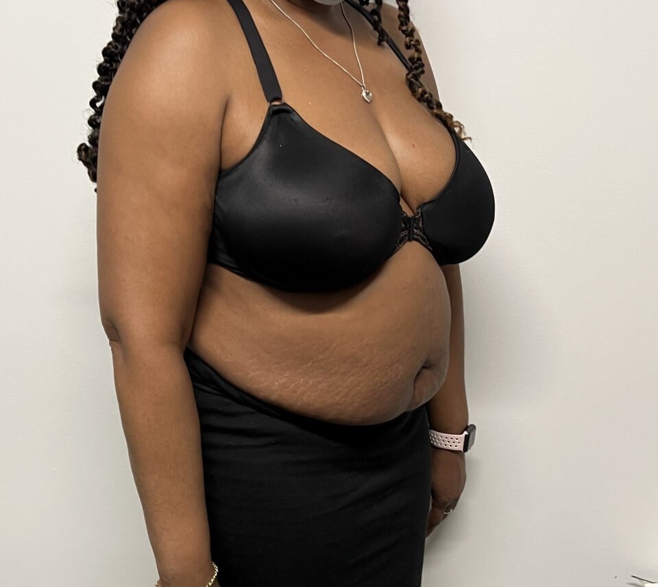 Tummy Tuck with Liposuction Before