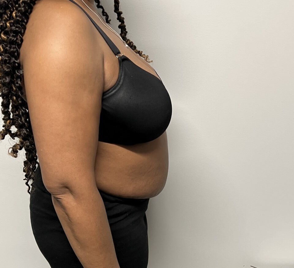 Tummy Tuck with Liposuction Before