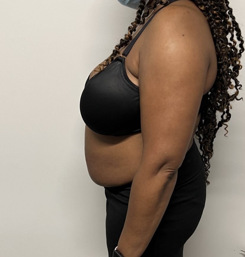 Tummy Tuck with Liposuction Before