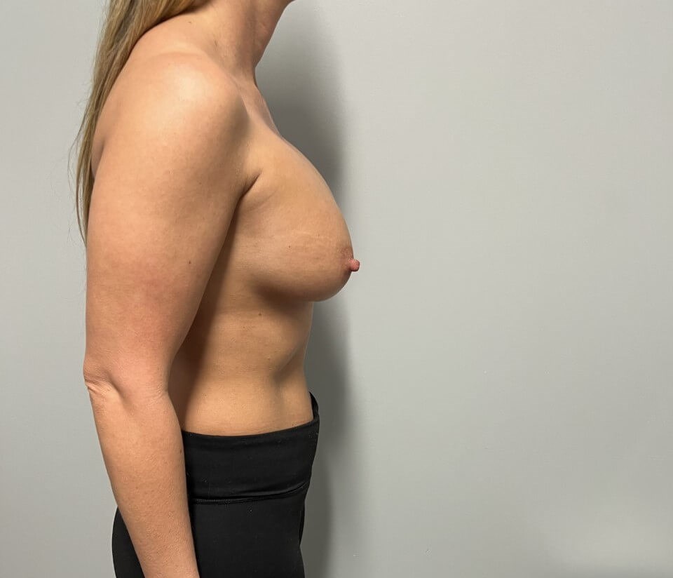 Breast Augmentation Revision Before