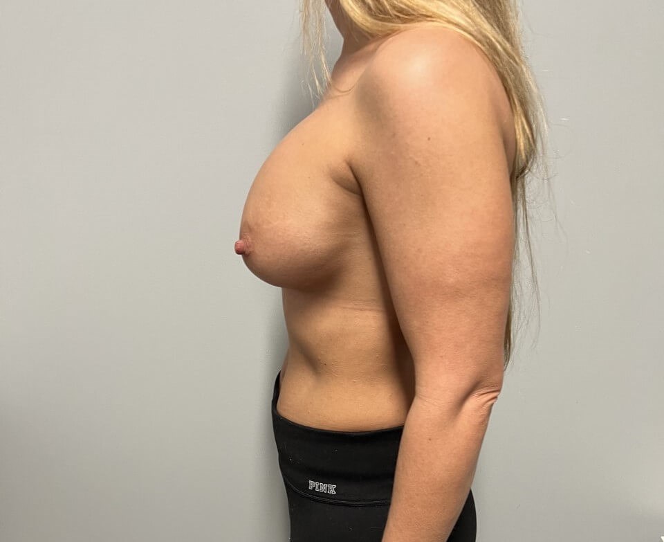 Breast Augmentation Revision Before