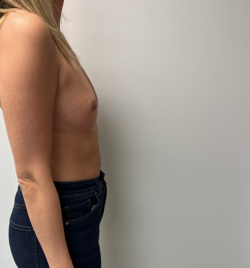 Breast Augmentation Before