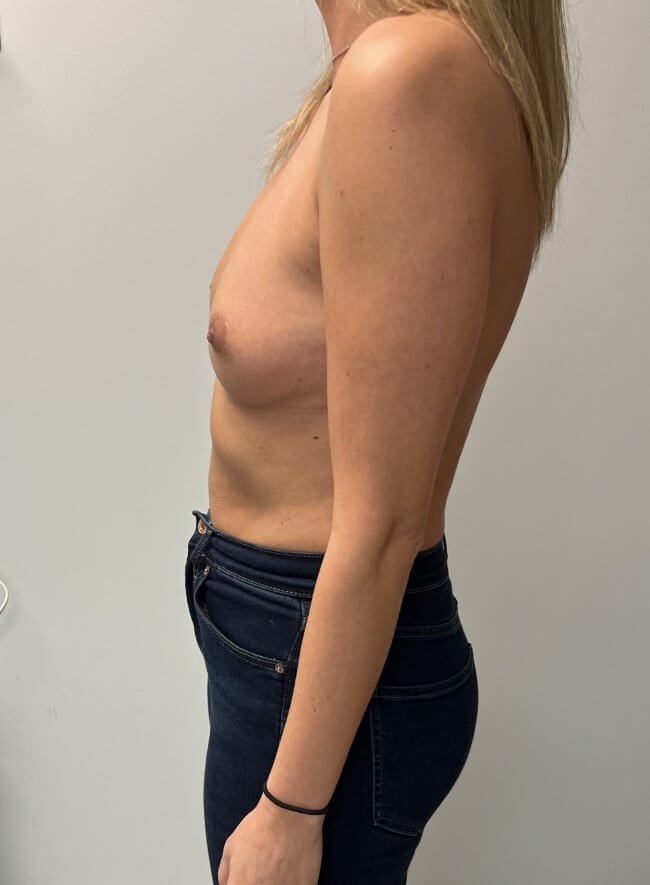 Breast Augmentation Before