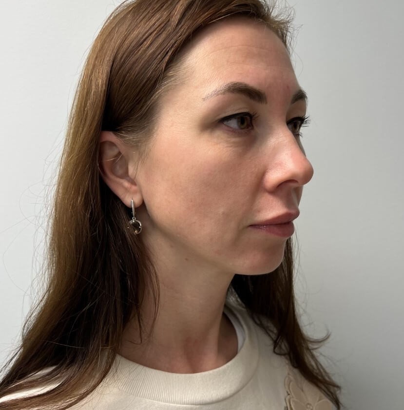 Upper Blepharoplasty Before