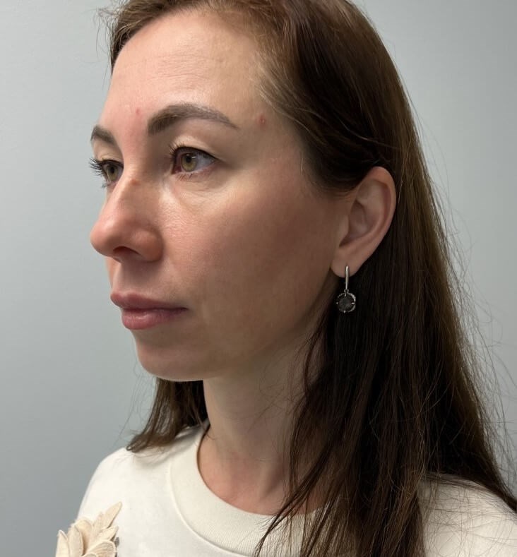 Upper Blepharoplasty Before