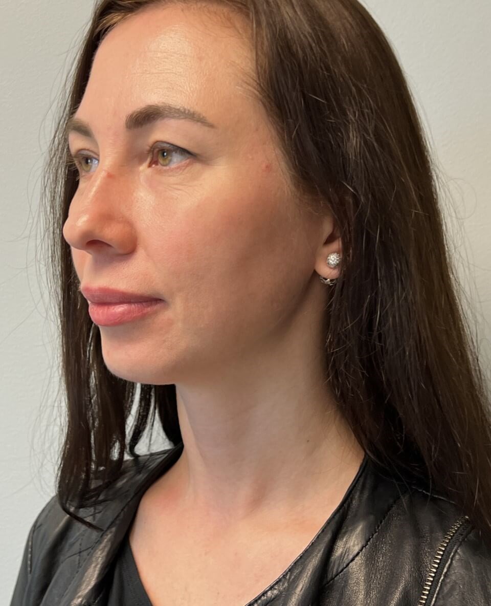 Upper Blepharoplasty After