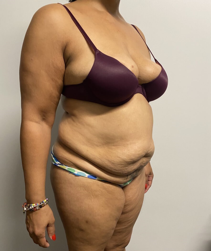 Abdominoplasty Surgery Before