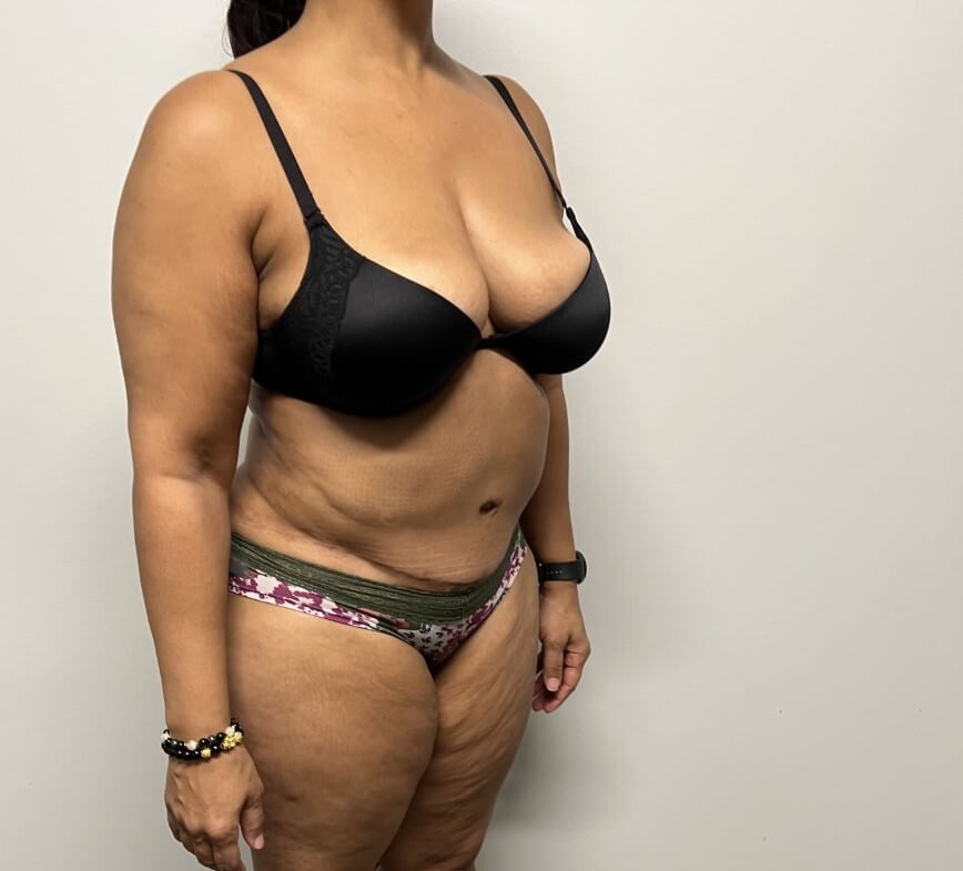 Abdominoplasty Surgery After