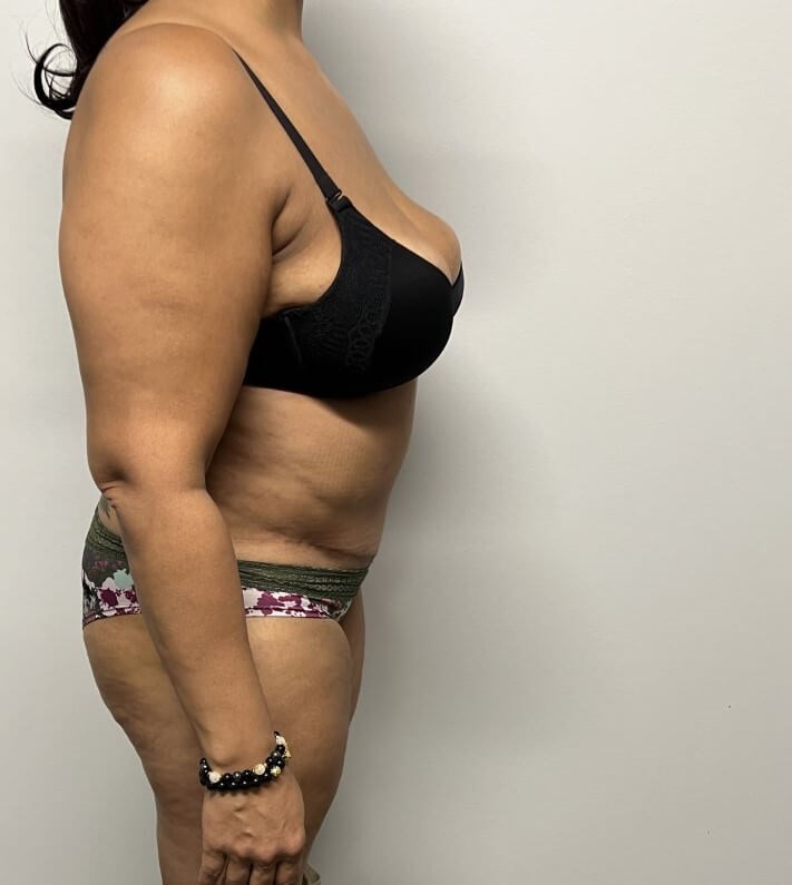 Abdominoplasty Surgery After