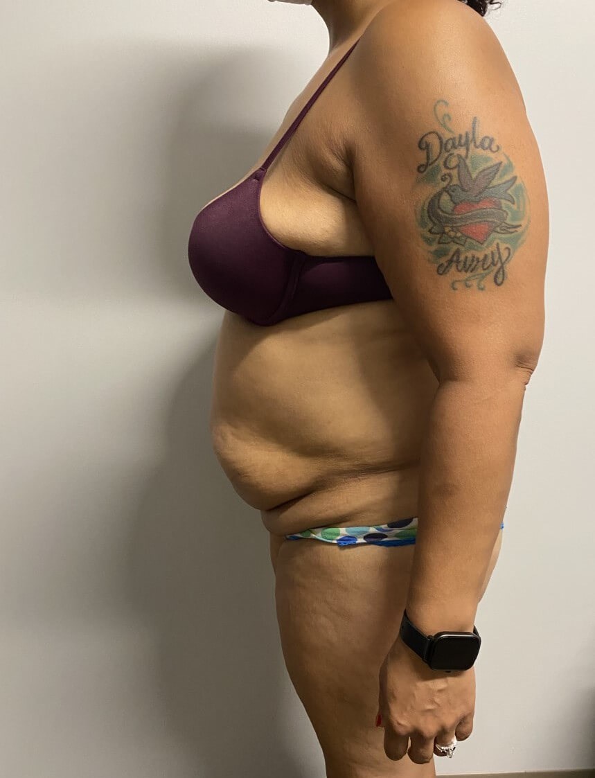 Abdominoplasty Surgery Before