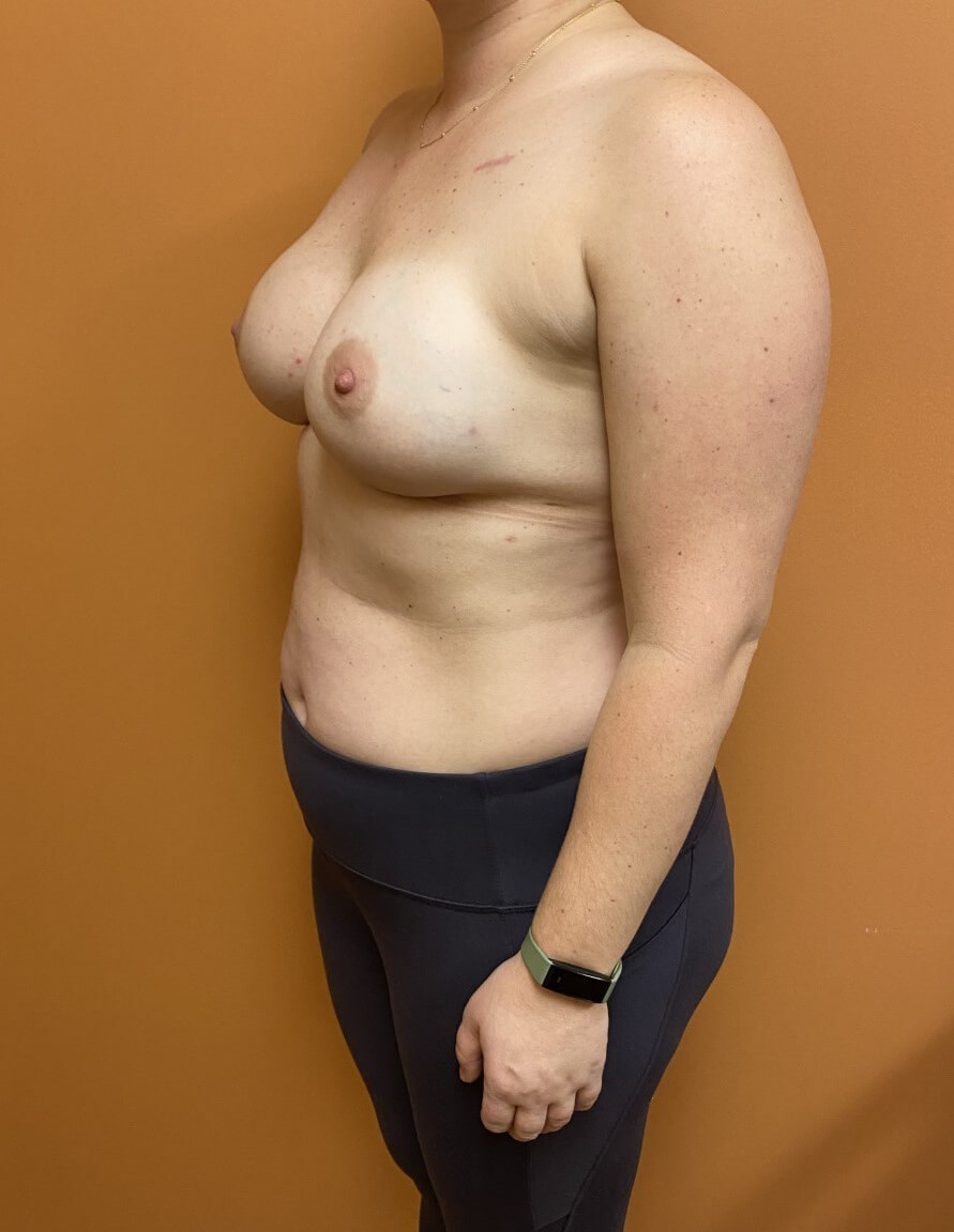 Nipple Sparing Reconstruction Before