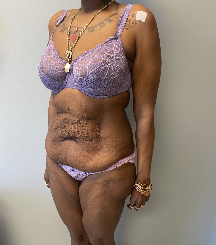 Tummy Tuck Surgery Before