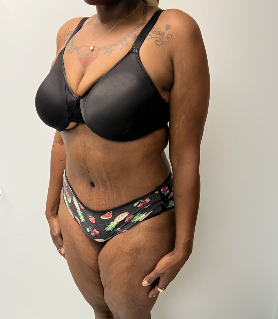 Tummy Tuck Surgery After