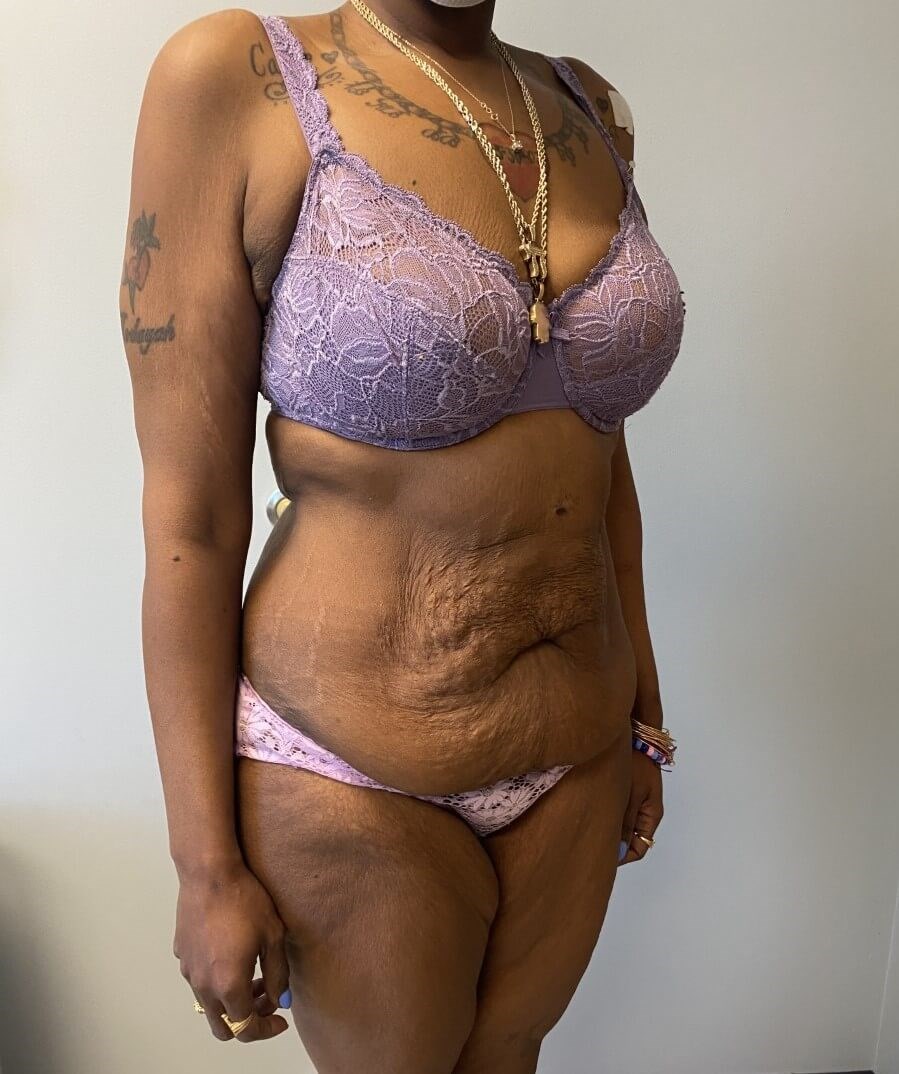 Tummy Tuck Surgery Before