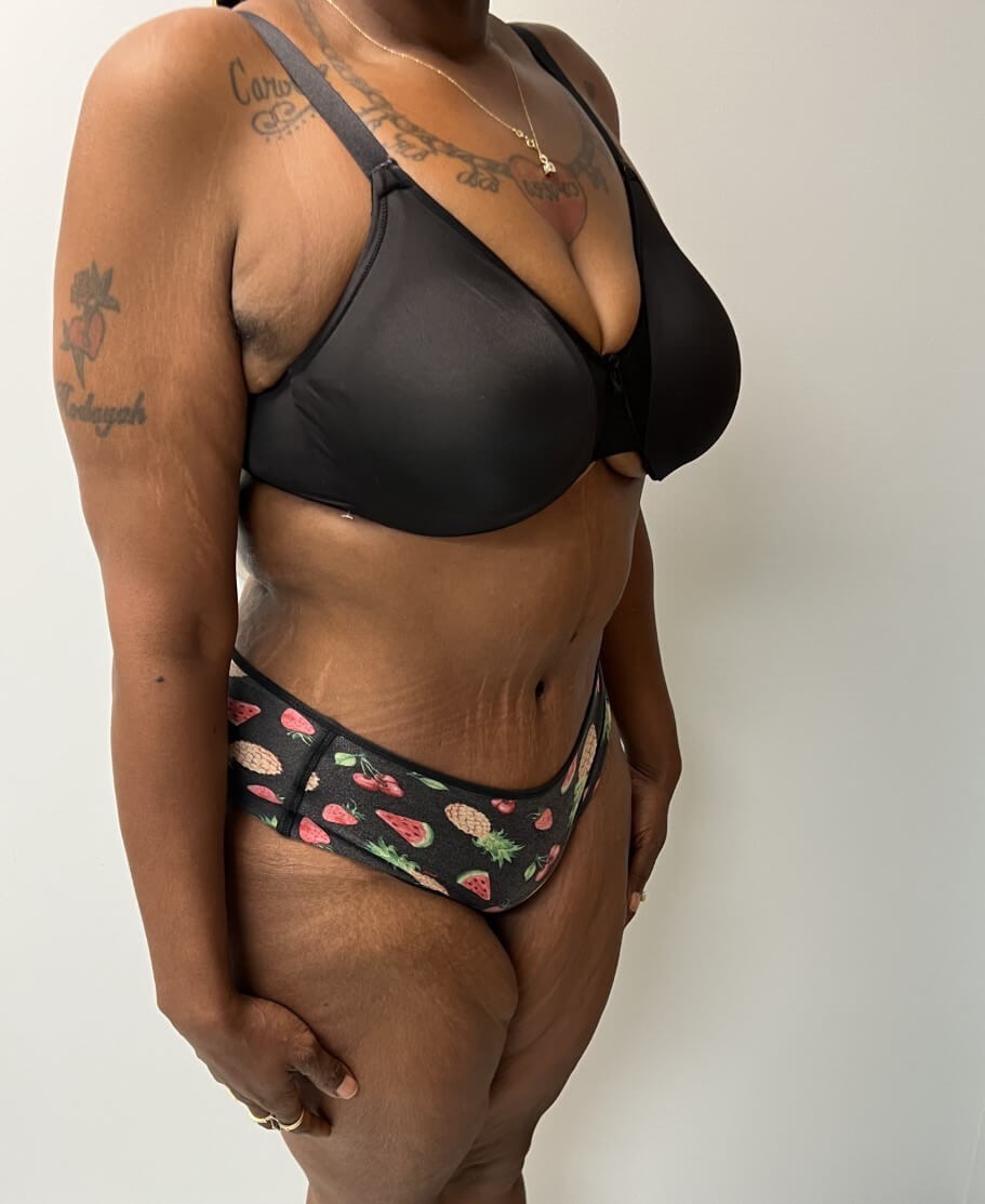 Tummy Tuck Surgery After